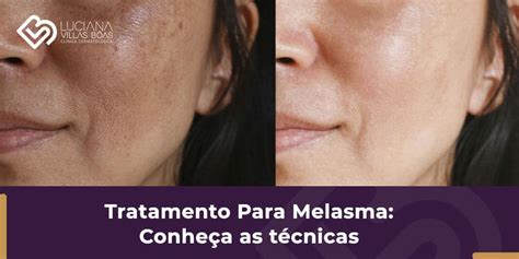 Tratamento Para Melasma Conhe A As T Cnicas