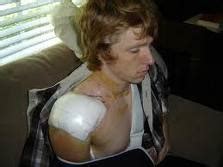 Rotator cuff surgery recovery time; life after rotator cuff surgery