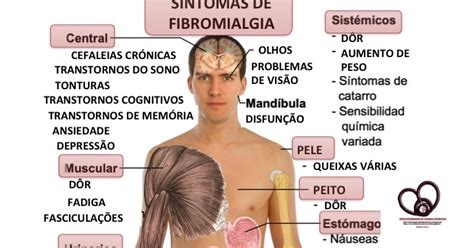 Fibromialgia O Que Sintomas Causas E Diagn Stico Brasil Escola