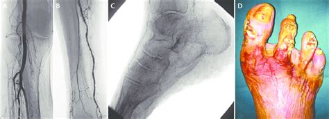 Diagnostic Angiography Occlusion Of The Anterior Tibial Artery And Download Scientific Diagram