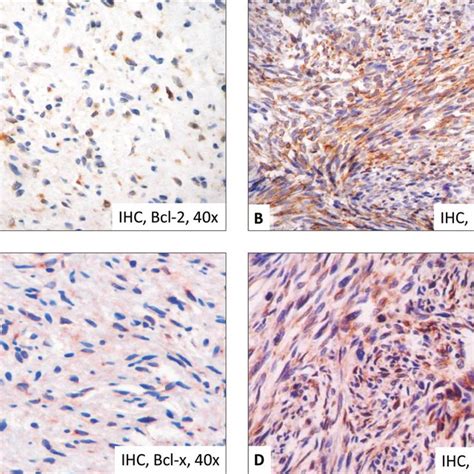 A Neurofibroma Showing Cytoplasmic Immunostaining For Bcl 2 B MPNST