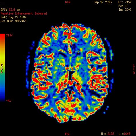 Brain Volume Bipolar Network News