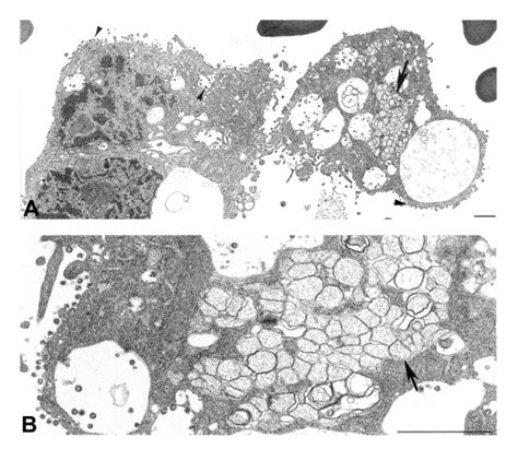 Ultrastructural Characteristics Of A Bronchial Alveolar Lavage Bal