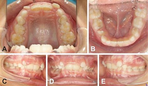 Initial Situation Of A Upper Arch B Lower Arch And Occlusal Download Scientific Diagram