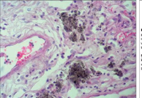 Silicosis Histology