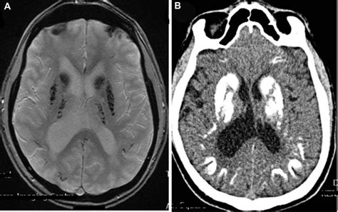 A Magnetic Resonance Axial Section T2 Gre Sequence With Extensive