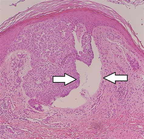 Carcinoma Basocelular Concise Medical Knowledge