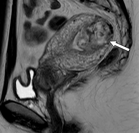 Gestational Trophoblastic Disease Clinical And Imaging Features Radiographics