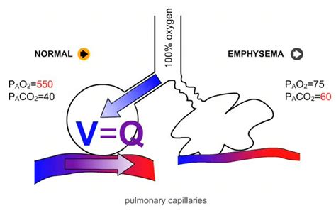 V Q Mismatching With High Concentration Oxygen Administration