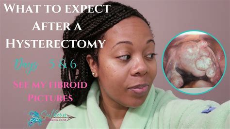 What To Expect After A Hysterectomy Days 5 And 6 See My Fibroid Pics