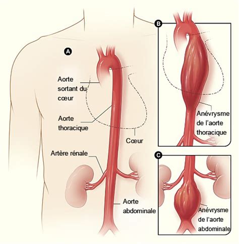 Chirurgie Vasculaire Et Chirurgie Endovasculaire Du Var