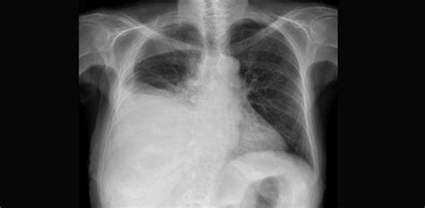 Versamento Pleurico Sistema Respiratorio In Pericolo MultiMedica