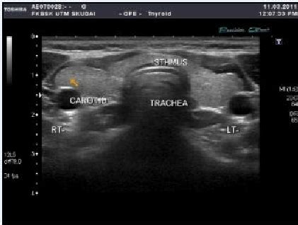 Labeled Thyroid Ultrasound