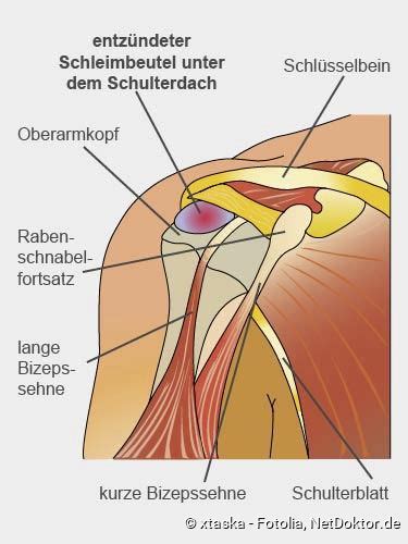 Schleimbeutelentz Ndung Beschreibung Ursachen Behandlung Netdoktor