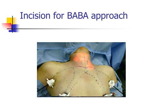 Ppt Endoscopic Thyroidectomy Abba Approach Powerpoint Presentation