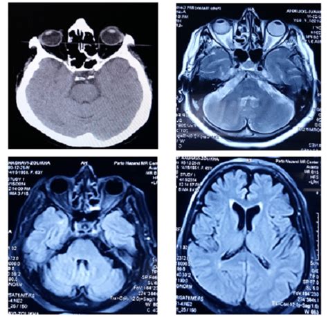 Brain Computed Tomography Scan And Magnetic Resonance Imaging Of