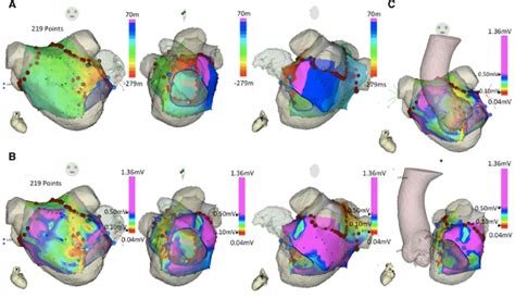 Electroanatomical Mapping Of The Left Atrium LA During The Atrial