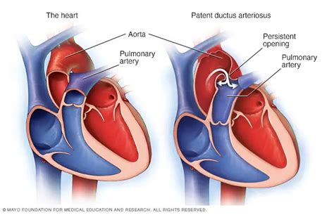 Patent Ductus Arteriosus Pda Voa英语教学网 Voa Learning English