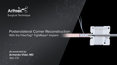 Arthrex Posterolateral Corner Reconstruction With The Fibertag