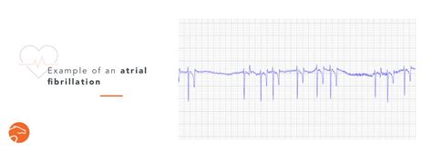 Arrhythmia In Horses How Serious Are They Equisense Blog