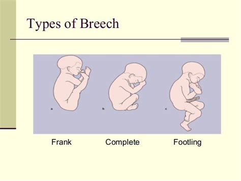 Breech presentation