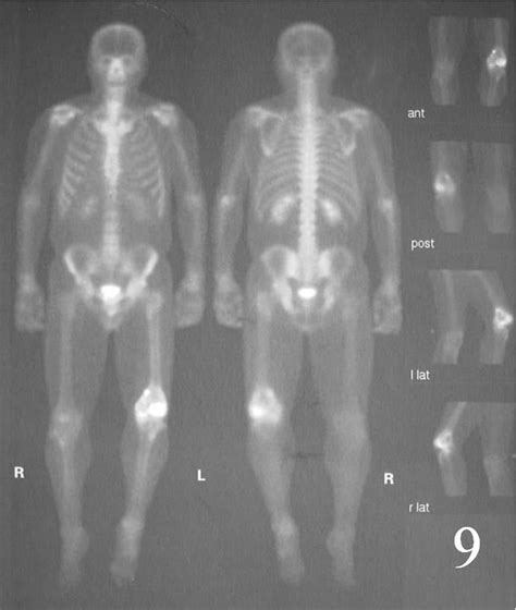 Giant Cell Tumor Of Bone Bone Tumors