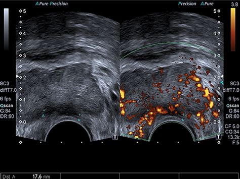 Ultrasonido De Próstata Diagnóstico Especializado Por Imagen