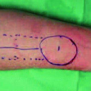 c.-Peroperative view of the flap and pedicle | Download Scientific Diagram