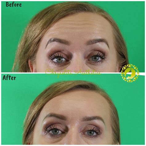 Before And After Gallery Houston Tx Chrysolite Aesthetics