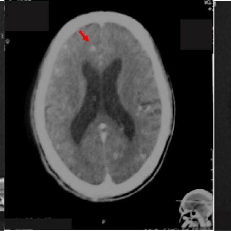 Imaging of patient A; contrast-head CT scan showed multiple... | Download Scientific Diagram