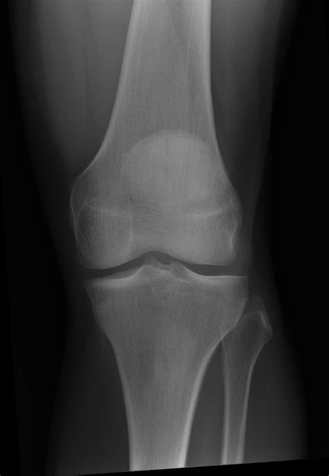 64 F presents with knee pain x 5 years : r/medizzy