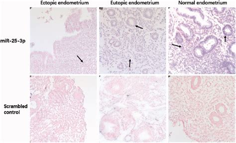 Mir 25 3p Expression In Ectopic Eutopic And Normal Endometrium The Download Scientific