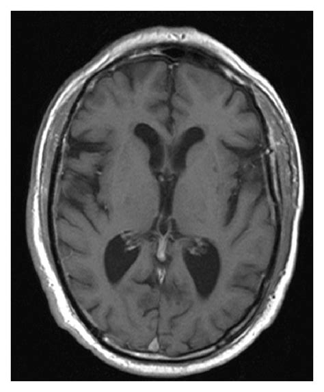 Mri T1—lacunar Infarction In Left Putamen Download Scientific Diagram