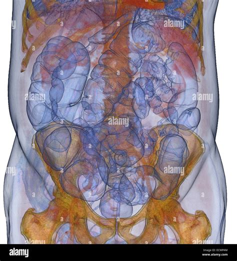 3D CT scan image of a CT colonography procedure Stock Photo - Alamy