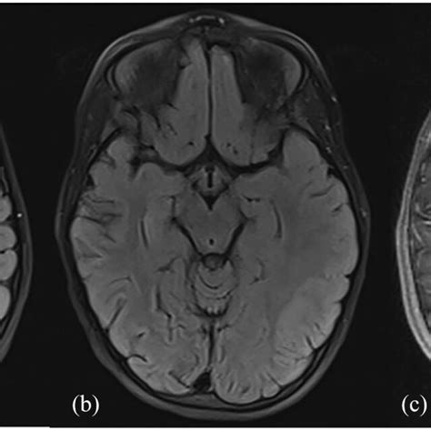 A And B Axial Flair And C Axial T Gadolinium Fs Sequences Of Our