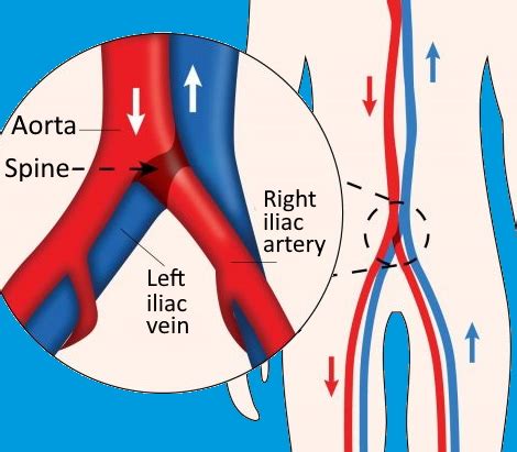 Iliac Venous Compression Syndrome Stent