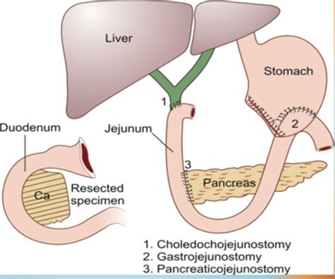 Approach To Pancreatic Masses Flashcards Quizlet