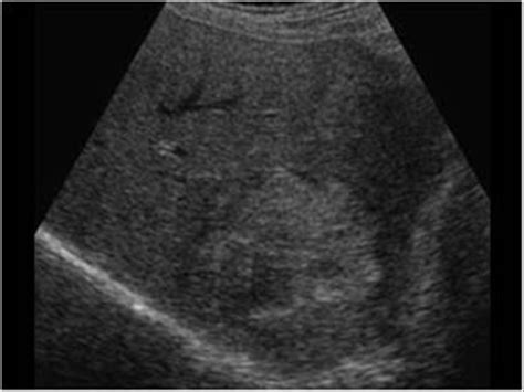 Abdomen And Retroperitoneum 1 1 Liver Case 1 1 7 Hepatocellular Free