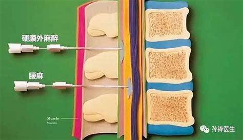 医学小品︱腰椎麻醉 Vs 硬膜外麻醉