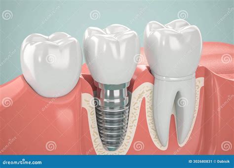 Tooth Implant Installed In Jaw Dental Surgery Stock Image Image Of