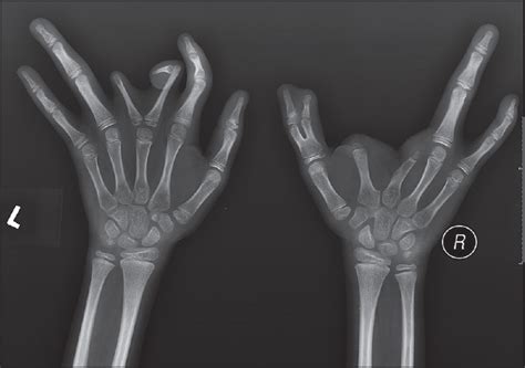 Ectrodactyly X Rays