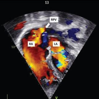 Echocardiography Showing A Four Chamber View With Partial Anomalous