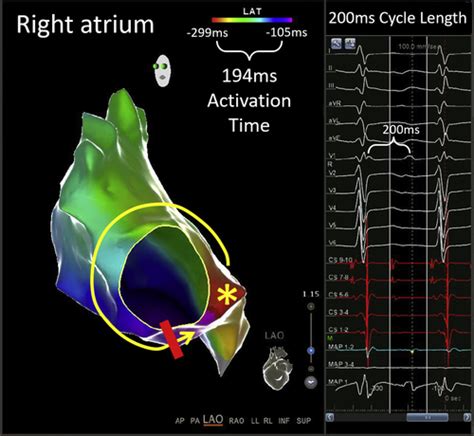 How To View Entrainment When Mapping Complex Atrial Tachycardias