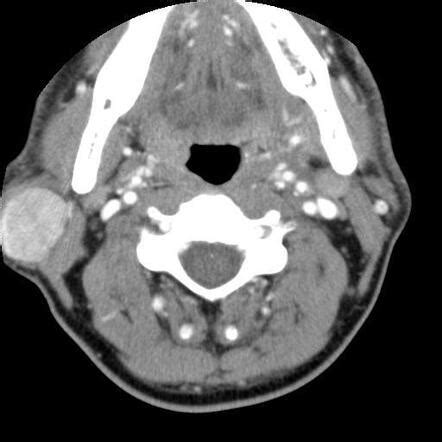 Pleomorphic Adenoma Radiology Case Radiopaedia Org