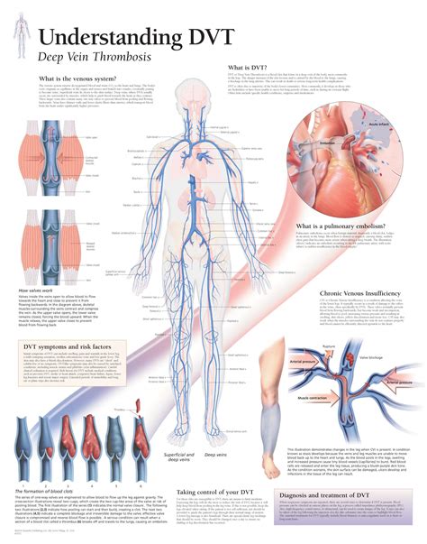 Deep Vein Thrombosis (DVT) 1652 - Anatomical Parts & Charts