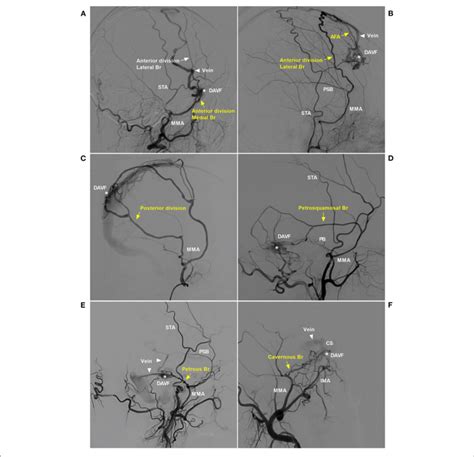 Pathological Anatomy Of The Mma As A Davf Feeder A Dsa Of The