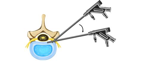 Endoscopic Discectomy Trimed Spine Joint