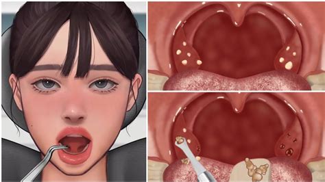 Asmr Cause Of Bad Breath Tonsil Stone Removal Animation And Extreme