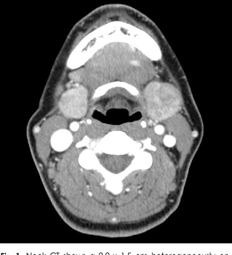 Figure 1 From Igg4 Related Chronic Sclerosing Sialadenitis In Both