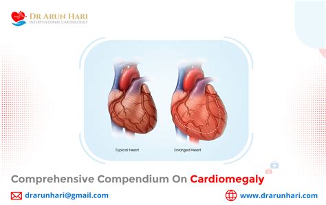 Comprehensive Compendium On Cardiomegaly Dr Arun Hari